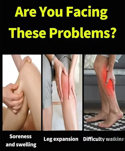 Wear shorts with confidence: a varicose vein cream that supports your veins. nkhluka