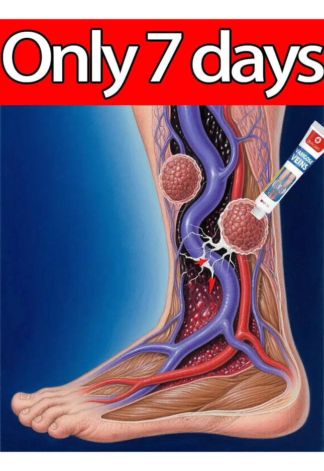 Wear shorts with confidence: a varicose vein cream that supports your veins. nkhluka